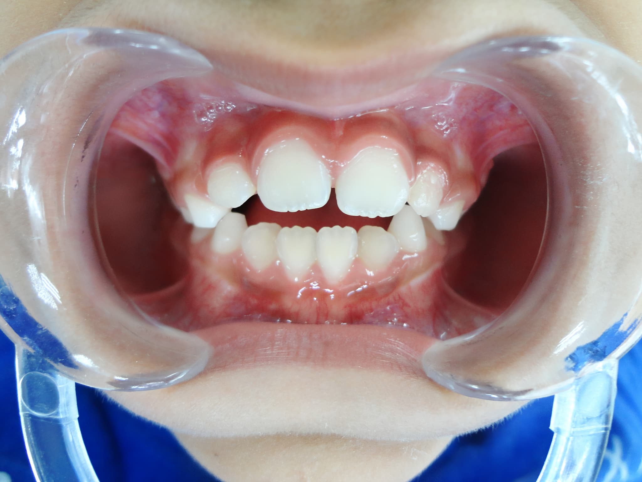 矯正を検討したほうがよい子どもの歯並び