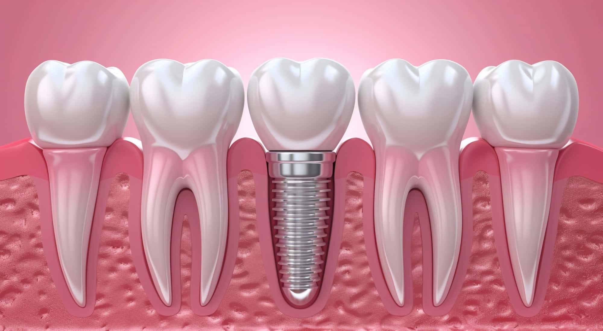 インプラントの断面模型