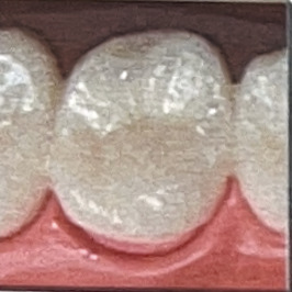 ジルコニア冠スーパー プレミアム