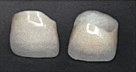 フルジルコニア冠