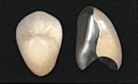 硬質レジン前装