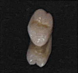 ジルコニア冠 ハードスーパー