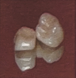 フルジルコニア冠