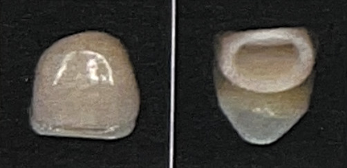 ジルコニア冠ハードスーパー